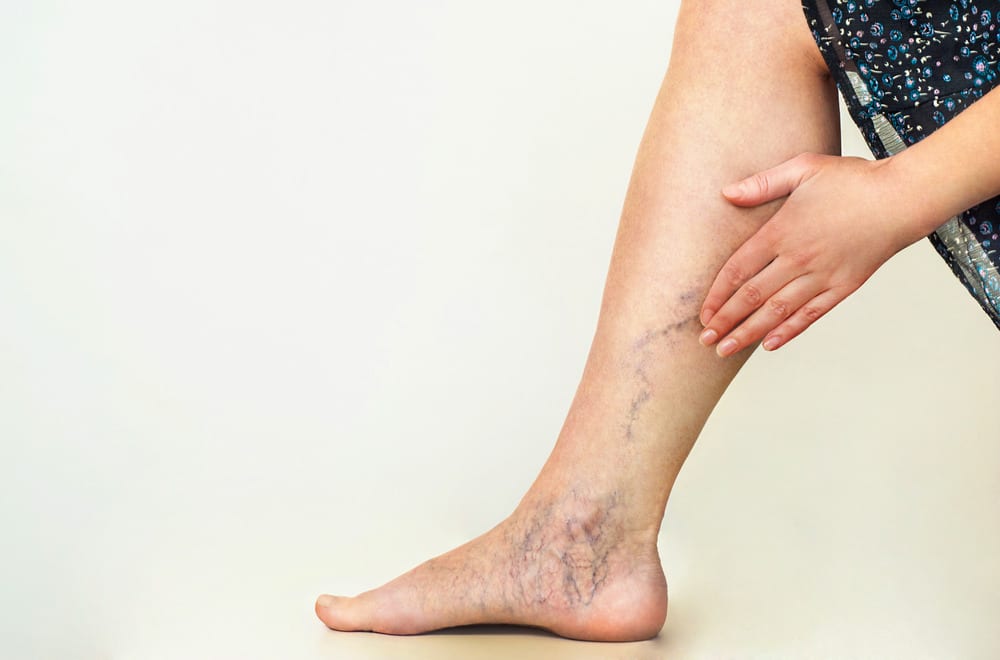venous disease